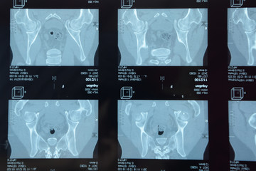 MRI sacroiliac articulation. Study of ankylosing spondyloarthritis patient. - obrazy, fototapety, plakaty