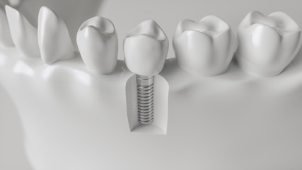 An implant in the jaw - 3d rendering - obrazy, fototapety, plakaty