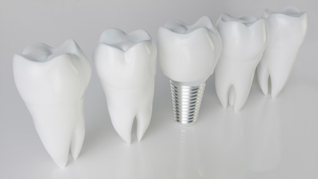 An implant compared to healthy teeth - 3d rendering