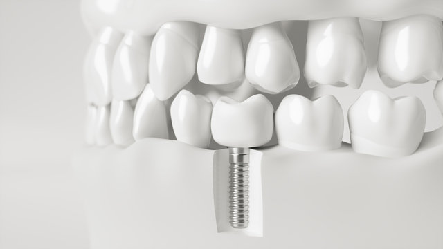 An implant in the jaw - 3d rendering