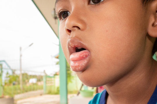 Hand foot mouth syndrome