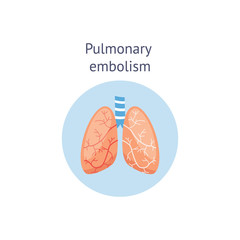 Pulmonary embolism medical educational scheme vector illustration isolated.