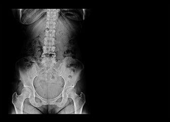 x-ray image of a woman (front side)  show  L-S spine AP and Lateral and blank area at right side.  Spinal Stenosis or vertebral stenosis or Lumbar Degenerative Spinal Canal Stenosis.