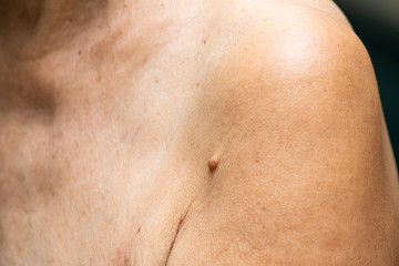 Brown mole on senior woman's  brachium, Medicine, Close up