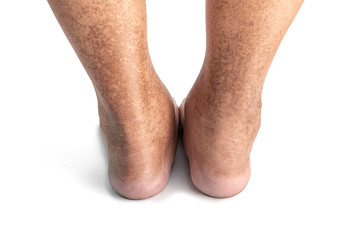 closeup skin at legs show mottled skin caused by Diabetes