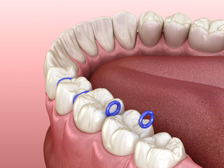 Rubber separator between teeth, preparation for braces placement. Medically accurate dental 3D illustration