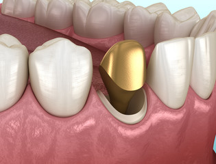 Golden stump pin tab on canaine tooth. Medically accurate dental 3D illustration