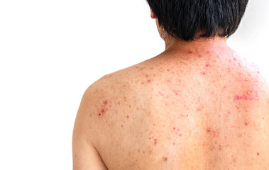 Men with acne, with red spots on the back.