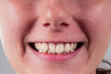 white smile with curvature tooth of young woman on whitw background in studio .treatment braces...