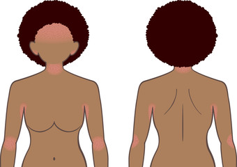 あせも・湿疹　上半身　女性