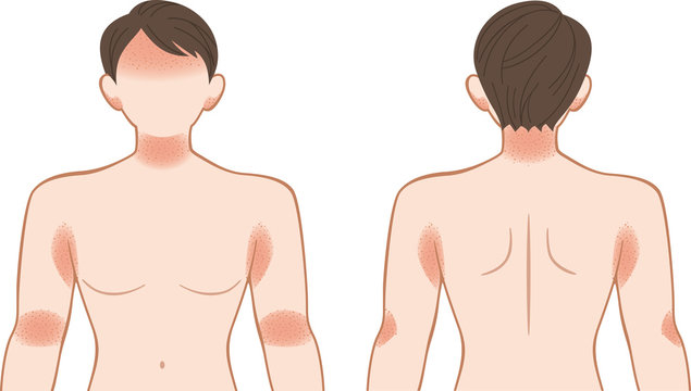 あせも・湿疹　上半身　男性