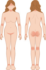 Fototapeta premium あせも・湿疹 全身 女性