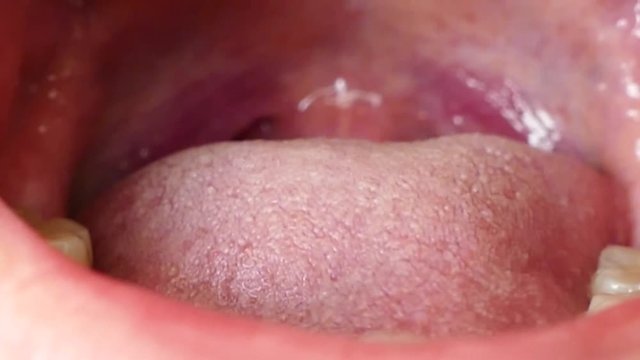 tonsils of a child, tonsils inflammation of a sick child,