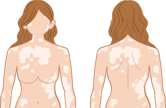 白斑　上半身　女性