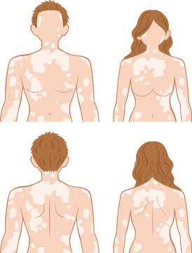 白斑　上半身　男女セット