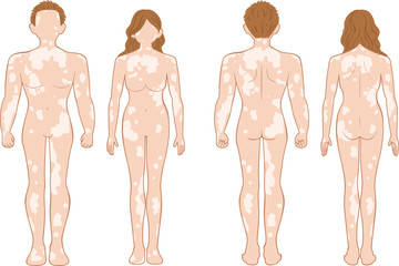 白斑　全身　男女セット