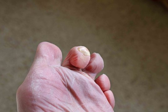 hammerr toe deformaty of the foot
