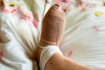 Bandaged foot a few hours after bunion and hammertoe surgery on the right foot of a woman in her 60's.