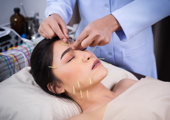 Fototapeta na wymiar woman undergoing acupuncture treatment on face