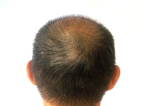 Men have black and white hair .. thin hair, bald head back ...See the scalp... White background