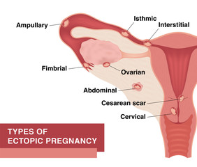 Types of ectopic pregnancy. Vector realistic medical illustration with inscriptions. Female reproductive organs. Frontal view in a cut.
