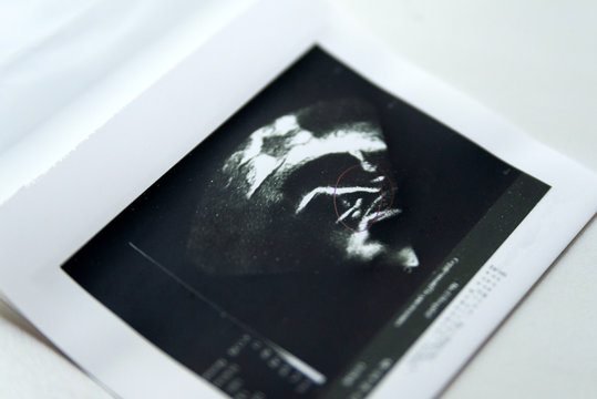Heart ultrasound image print on paper