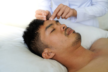 Fototapeta na wymiar Closeup of hand performing acupuncture therapy young Asian man's face