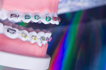 Dental brackets teeth straighteners