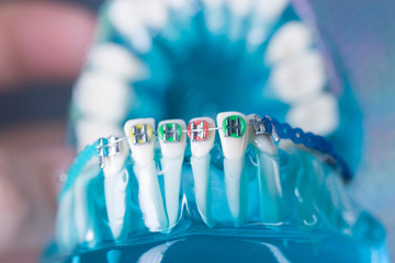 Dental brackets teeth straighteners