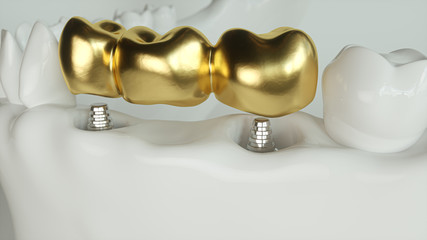 Implants with golden dental bridge - 3d rendering