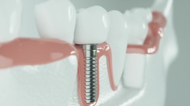 Dental implant next to healthy tooth as an animation - 3D Rendering