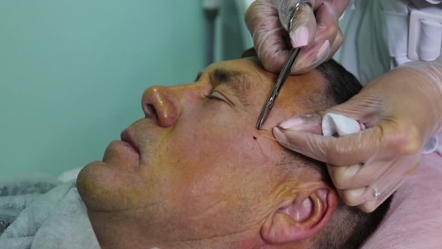 Treatment of baldness with beauty injections. Cosmetologist hands in gloves make a subcutaneous injection. Plasmalifting male patient.