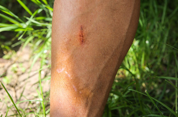 Old scar on man's leg. Accident in the past.