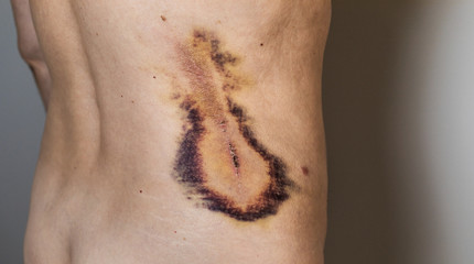 Large painful hematoma