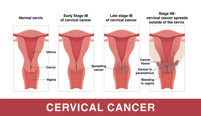 cervical cancer, normal and different stages of disease development.