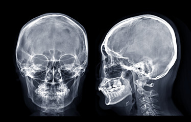  Skull x-ray image of Human skull  AP and Lateral  isolated on Black Background.