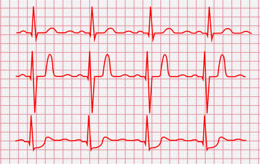 Cardiogram or Pulse Line on a Pink Grid. Vector