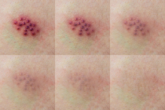 Virus on the body. Rash of Shingles on the skin. Bright red blisters of zoster. Smallpox Disease. A set of photos.