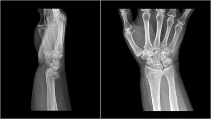 Film X ray wrist radiograph show distal forearm bone broken ( distal end radius fracture). The...