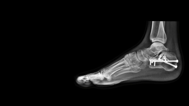 Film ankle X-ray radiograph showing heel bone broken (calcaneus fracture) which treated by open reduction and internal fixation(ORIF) with plate and screws. Medical technology and instrument concept.