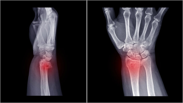 Film X-ray wrist radiograph show lower end of forearm bone broken (distal end radius fracture) from traffic accident. Highlight on broken site and painful area.  Medical imaging and technology concept