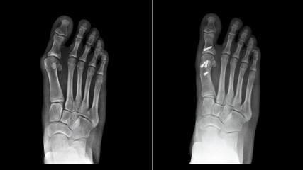 Compare between before and after surgery. Film x-ray foot radiograph show Hallux valgus deformity...
