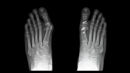 Film X ray foot radiograph show Hallux valgus deformity or Bunion disease which Right side treated...