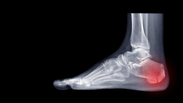 Film ankle X-ray radiograph showing heel bone fracture (Calcaneus fracture) after fall from height. The patient had heel pain. Highlight on broken bone site and painful area. Medical imaging concept