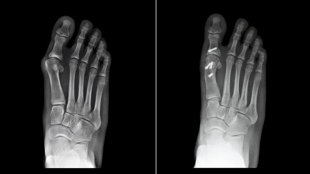 Compare between before and after surgery. Film x-ray foot radiograph show Hallux valgus deformity or Bunion disease which treatment by corrective osteotomy fixation. Medical technology concept 