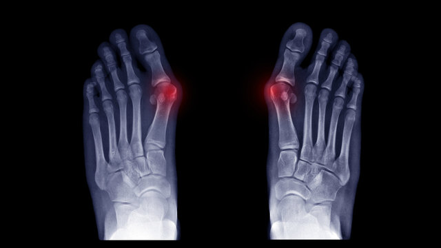 Film X-ray foot radiograph show both Hallux valgus deformity or Bunion disease. The patient has big toe pain symptom ,shoe wearing and cosmetic problem. Highlight on painful area. Medical concept
