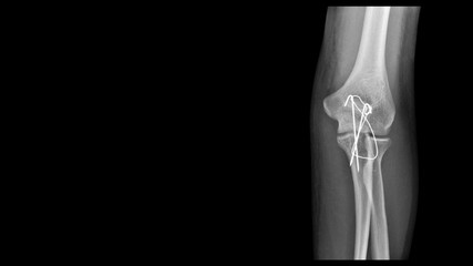 Film X ray elbow radiograph show elbow bone broken (proximal Ulna or Olecranon fracture) treated by surgery with tension band wiring fixation(TBW). Medical technology and imaging concept