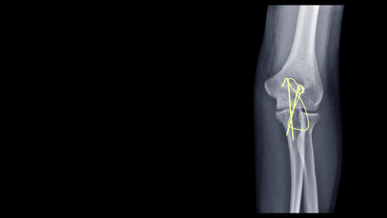 Film X-ray elbow radiograph show elbow bone broken (proximal Ulna or Olecranon fracture) treated by surgery with tension band wiring fixation(TBW). Highlight on medical instrument. technology concept