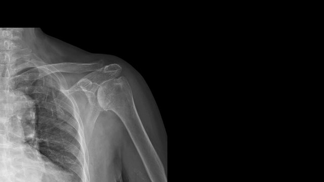 Film X-ray shoulder radiograph show degenerative osteoarthritis disease of glenohumeral and acromioclavicular joint (OA shoulder disorder). Patient has pain and stiffness problem. medical concept