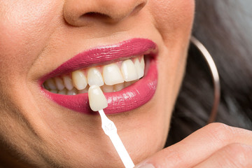 Using shade guide at mouth to check veneer of tooth crown